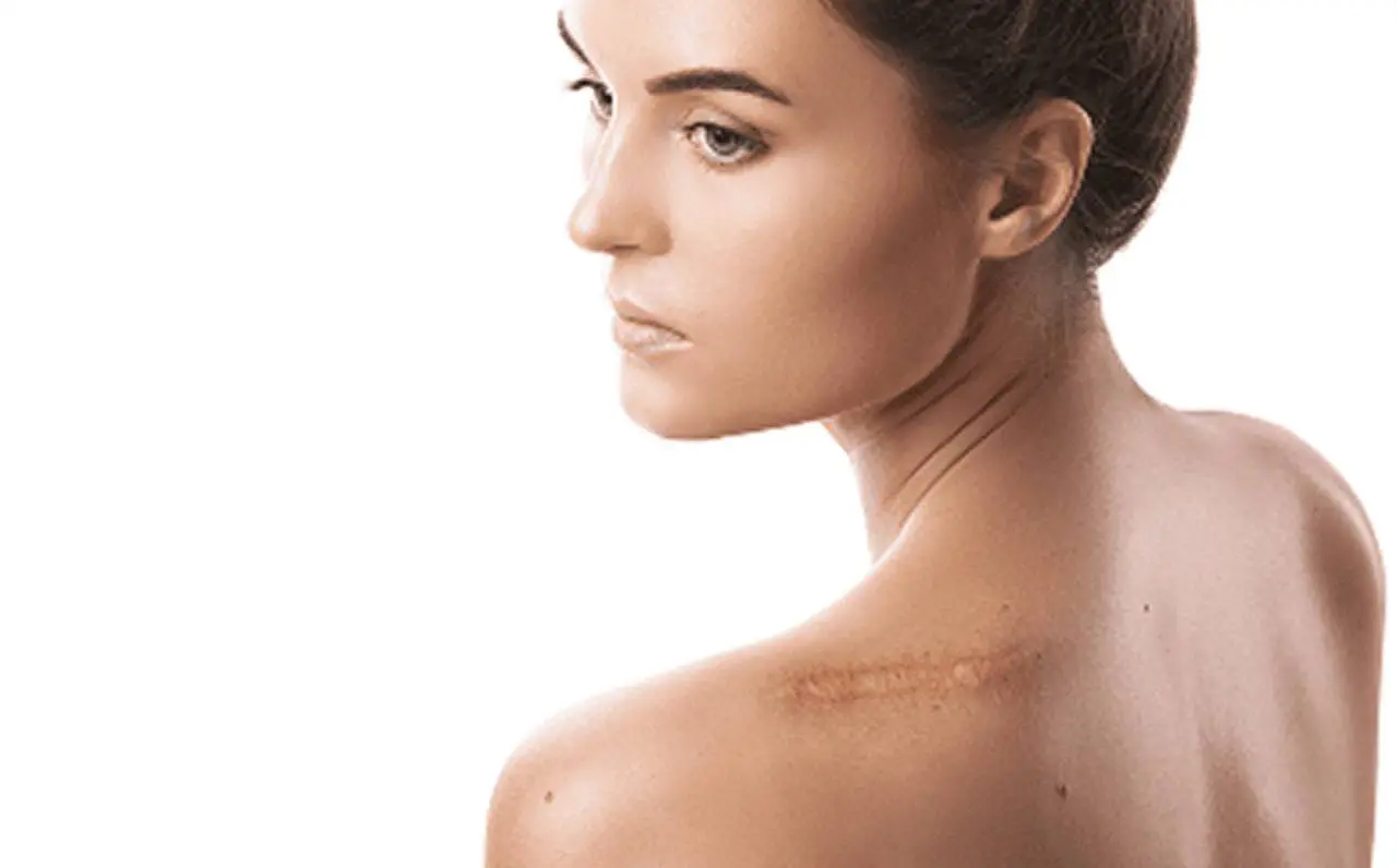 Back view of woman with scar