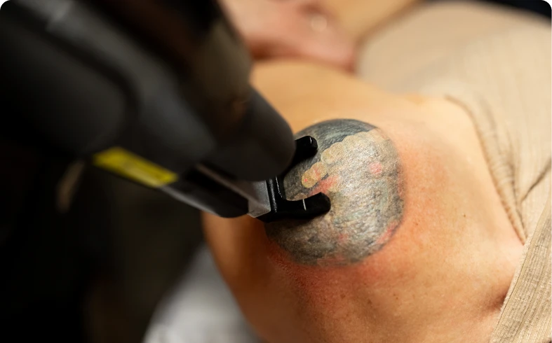 Laser removing colorful tattoo